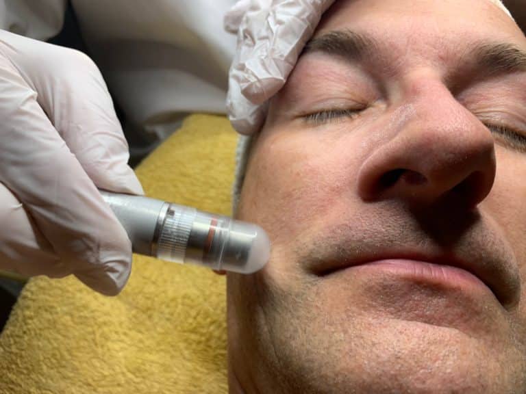 Microdermabrasion, Schleifen