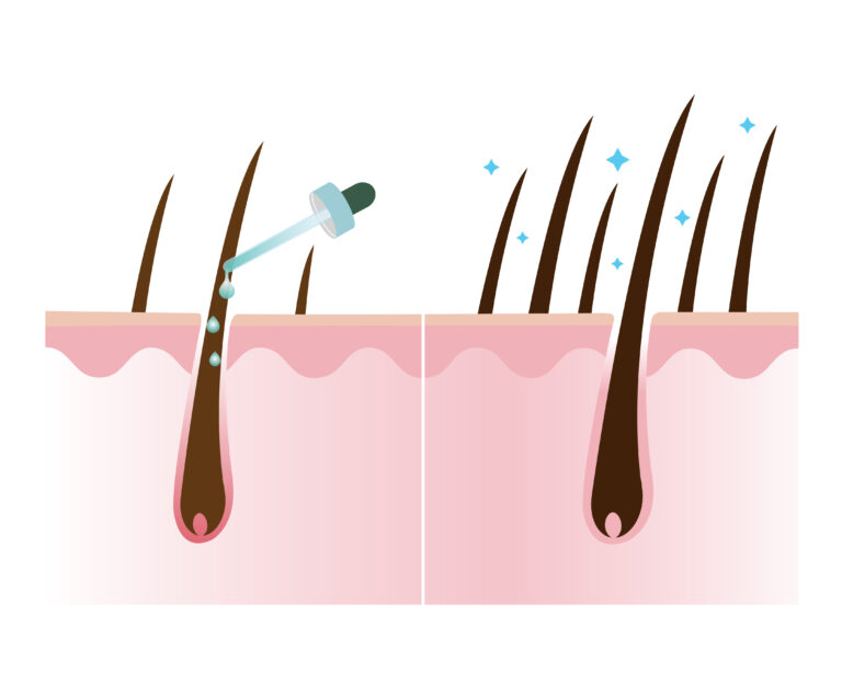 Hair thickening with azelaic acid, hair growth