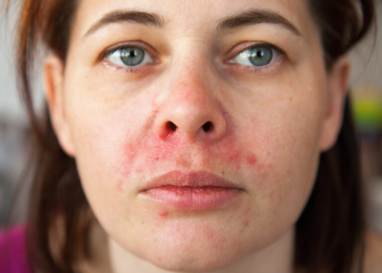 perioral dermatitis, woman's face with perioral dermatitis